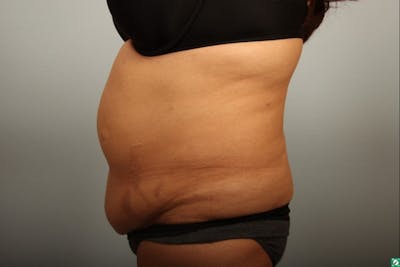 Tummy Tuck (Abdominoplasty) Before & After Gallery - Patient 154474 - Image 1