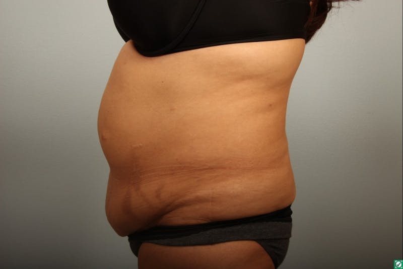 Tummy Tuck (Abdominoplasty) Before & After Gallery - Patient 154474 - Image 1