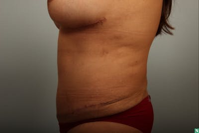 Tummy Tuck (Abdominoplasty) Before & After Gallery - Patient 154474 - Image 2
