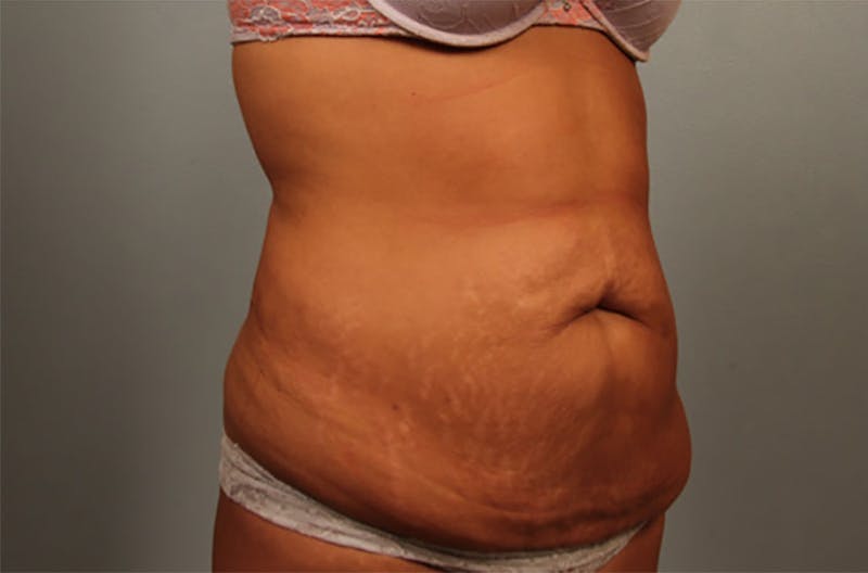 Tummy Tuck (Abdominoplasty) Before & After Gallery - Patient 262383 - Image 1