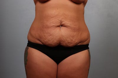 Tummy Tuck (Abdominoplasty) Before & After Gallery - Patient 418137 - Image 1