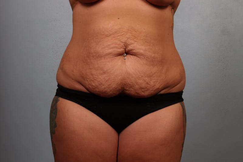 Tummy Tuck (Abdominoplasty) Before & After Gallery - Patient 418137 - Image 1