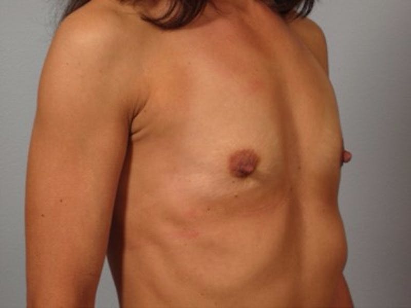 Breast Augmentation Before & After Gallery - Patient 313833 - Image 1