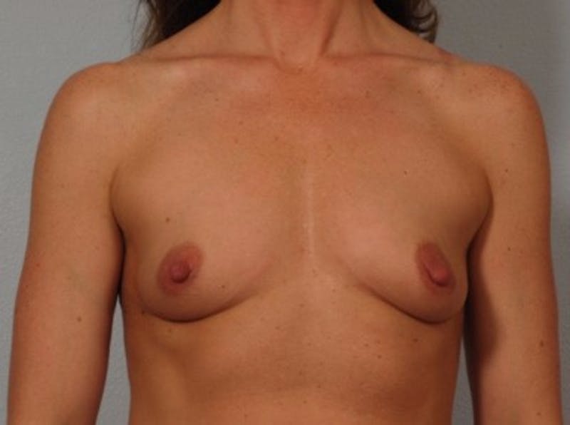 Breast Augmentation Before & After Gallery - Patient 388904 - Image 1