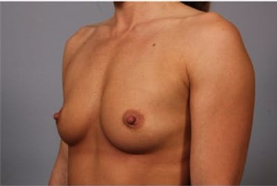 Breast Augmentation Before & After Gallery - Patient 327142 - Image 1