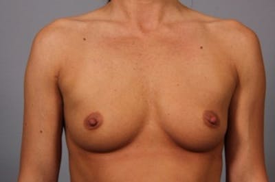 Breast Augmentation Before & After Gallery - Patient 162654 - Image 1