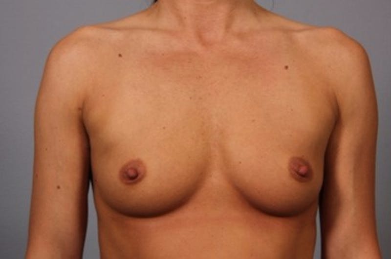 Breast Augmentation Before & After Gallery - Patient 162654 - Image 1