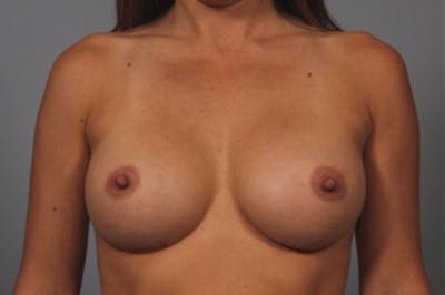 Breast Augmentation Before & After Gallery - Patient 162654 - Image 2