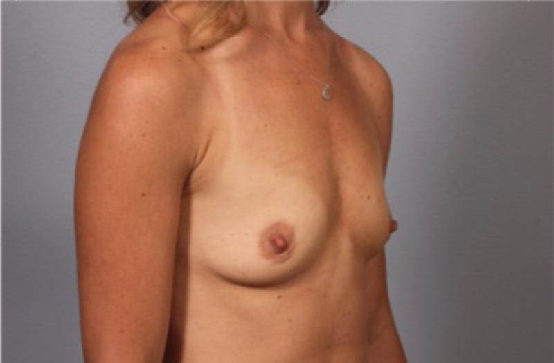 Breast Augmentation Before & After Gallery - Patient 357960 - Image 1