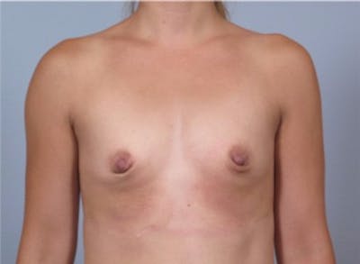 Breast Augmentation Before & After Gallery - Patient 911324 - Image 1