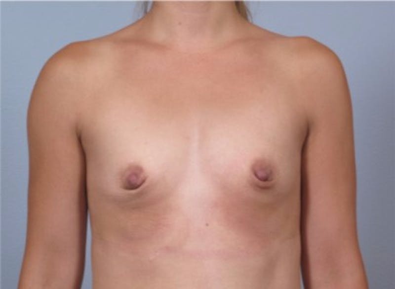 Breast Augmentation Before & After Gallery - Patient 911324 - Image 1