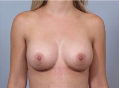 Breast Augmentation Before & After Gallery - Patient 911324 - Image 2