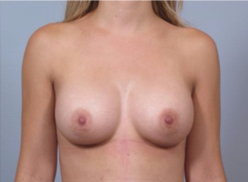 Breast Augmentation Before & After Gallery - Patient 911324 - Image 2