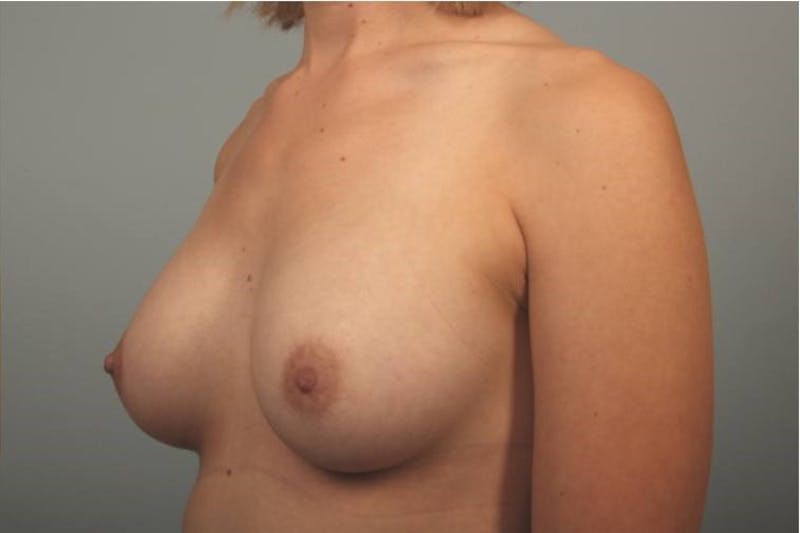 Breast Augmentation Before & After Gallery - Patient 341624 - Image 2