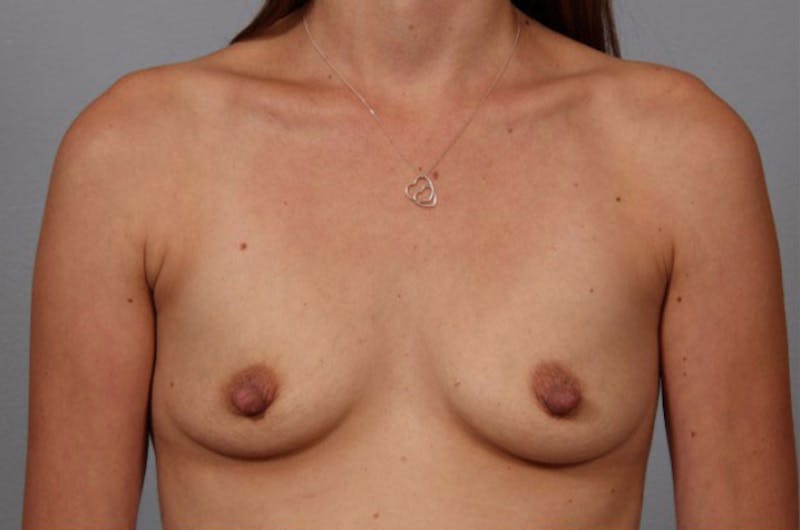 Breast Augmentation Before & After Gallery - Patient 132928 - Image 1
