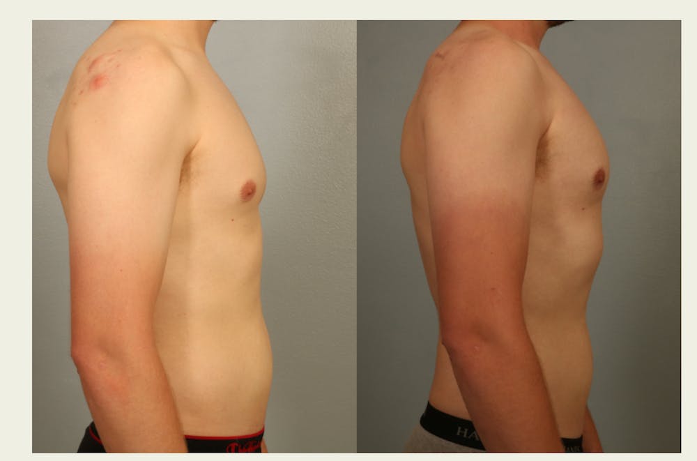 emsculpt before after