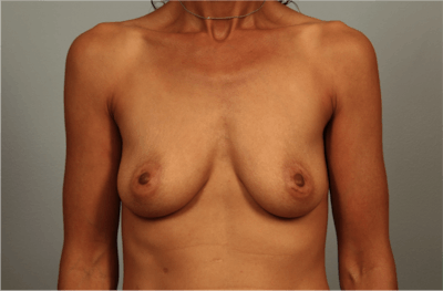 Breast Augmentation Before & After Gallery - Patient 203536 - Image 1