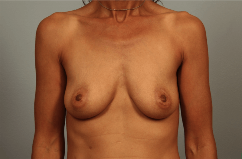 Breast Augmentation Before & After Gallery - Patient 203536 - Image 1
