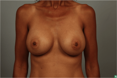 Breast Augmentation Before & After Gallery - Patient 203536 - Image 2