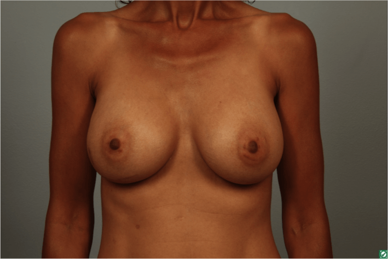 Breast Augmentation Before & After Gallery - Patient 203536 - Image 2
