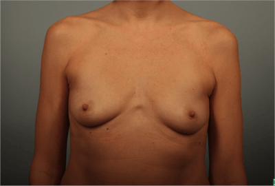 Breast Augmentation Before & After Gallery - Patient 342673 - Image 1