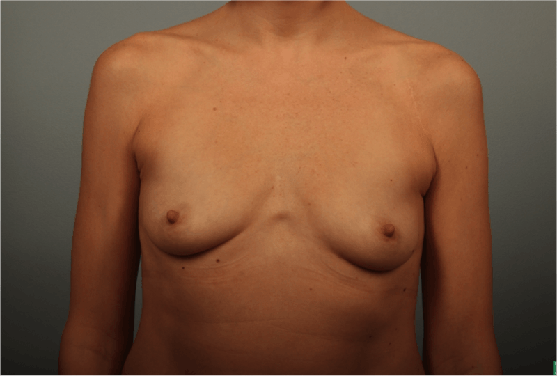 Breast Augmentation Before & After Gallery - Patient 342673 - Image 1