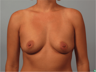 Breast Augmentation Before & After Gallery - Patient 282968 - Image 1