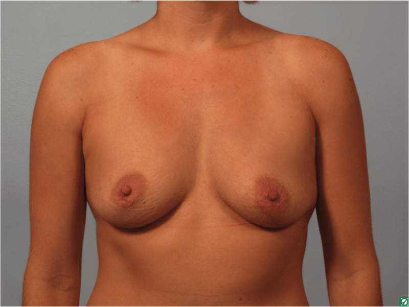 Breast Augmentation Before & After Gallery - Patient 282968 - Image 1