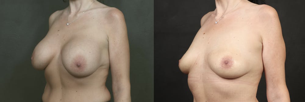 Before and After of Perkylift after breast implant removal example 1