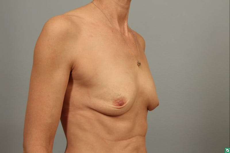 Breast Augmentation Before & After Gallery - Patient 945079 - Image 1