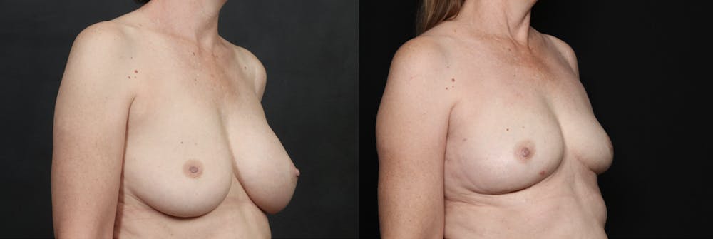 Before and After of Perkylift after breast implant removal example 2