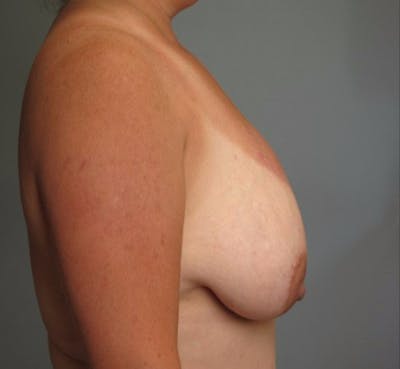 Breast Augmentation with Lift Before & After Gallery - Patient 138145 - Image 1
