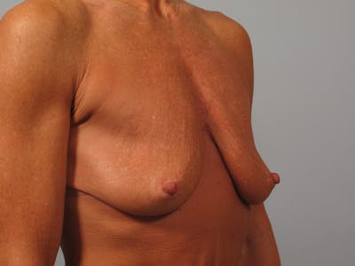 Breast Augmentation with Lift Before & After Gallery - Patient 179902 - Image 1
