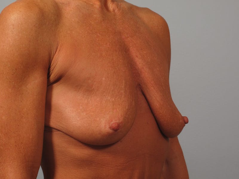 Breast Augmentation with Lift Before & After Gallery - Patient 179902 - Image 1