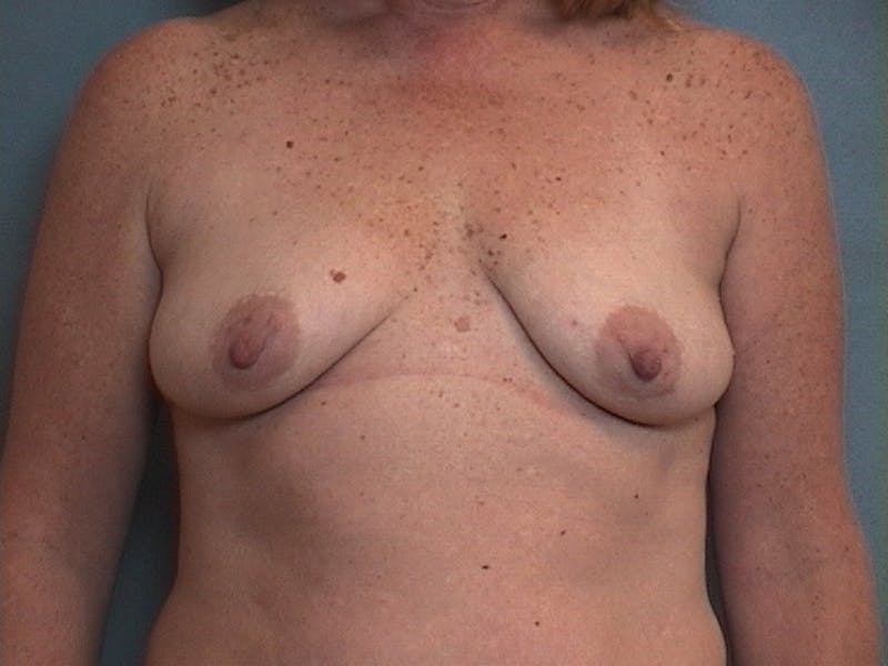 Breast Augmentation with Lift Before & After Gallery - Patient 537412 - Image 1