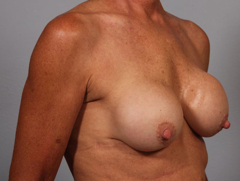 Breast Implant Correction Before & After Gallery - Patient 139492 - Image 1