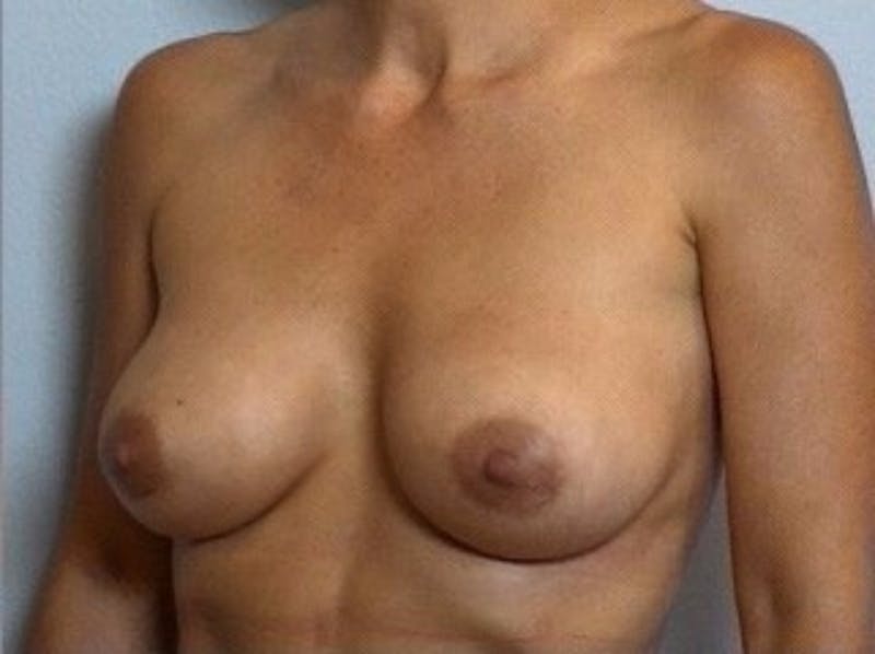 Breast Implant Correction Before & After Gallery - Patient 442954 - Image 2