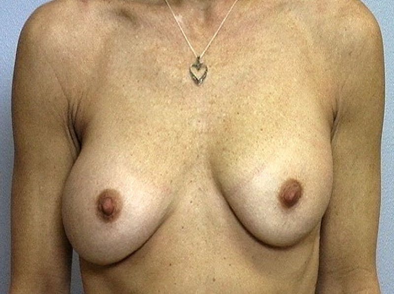 Breast Implant Correction Before & After Gallery - Patient 390793 - Image 1