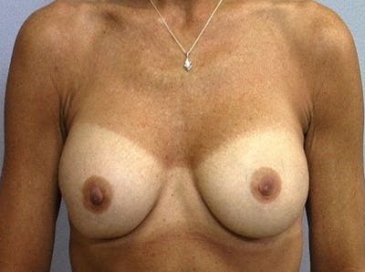 Breast Implant Correction Before & After Gallery - Patient 390793 - Image 2