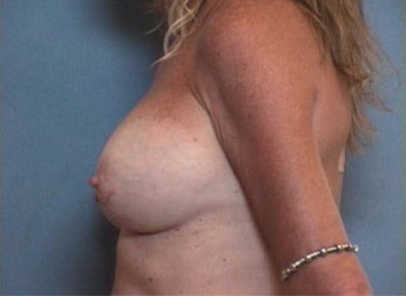 Breast Implant Correction Before & After Gallery - Patient 139009 - Image 2