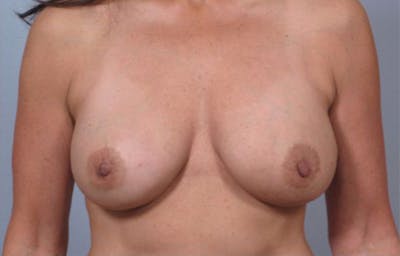 PerkyLift Before & After Gallery - Patient 428927 - Image 2