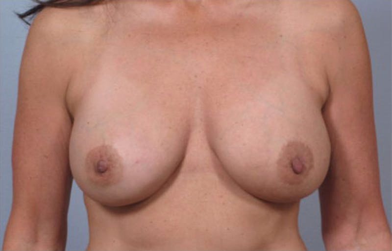 PerkyLift Before & After Gallery - Patient 428927 - Image 2