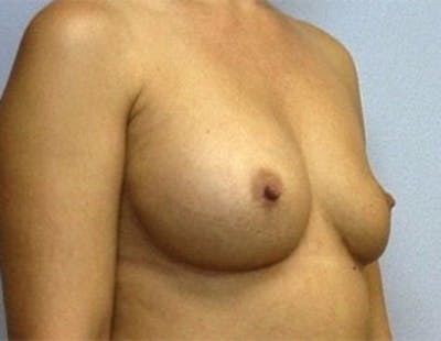 Breast Implant Correction Before & After Gallery - Patient 109905 - Image 1