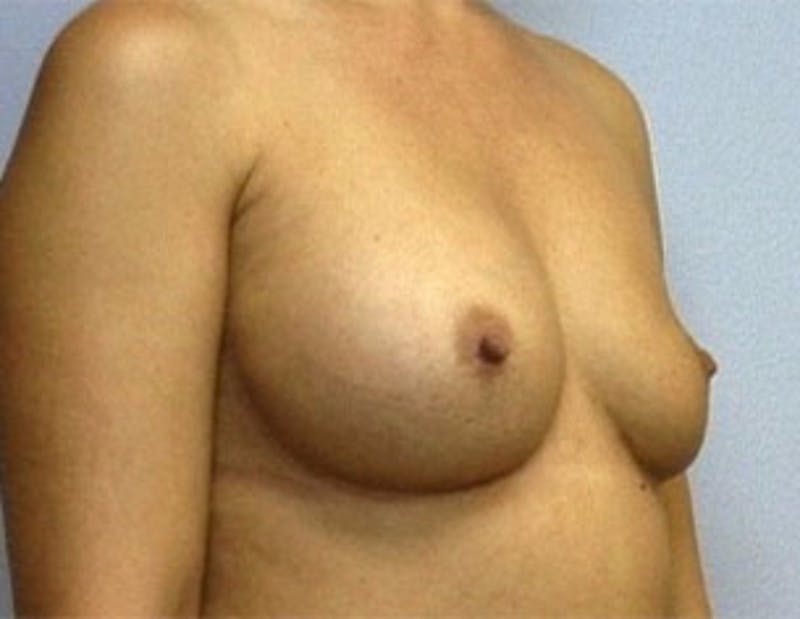 Breast Implant Correction Before & After Gallery - Patient 109905 - Image 1