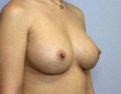 Breast Implant Correction Before & After Gallery - Patient 109905 - Image 2