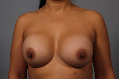 Breast Implant Correction Before & After Gallery - Patient 854034 - Image 1