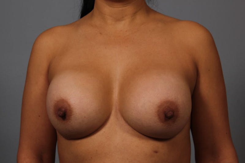 Breast Implant Correction Before & After Gallery - Patient 854034 - Image 1