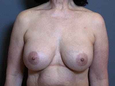 Breast Implant Correction Before & After Gallery - Patient 293227 - Image 2
