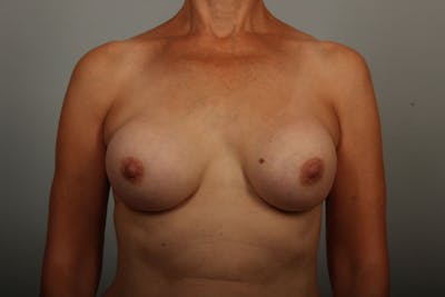 Breast Implant Correction Before & After Gallery - Patient 284741 - Image 1