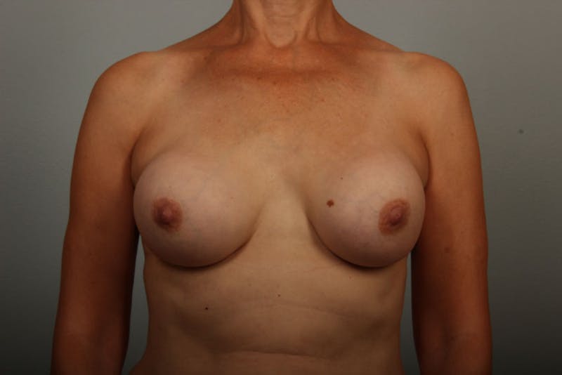Breast Implant Correction Before & After Gallery - Patient 284741 - Image 1